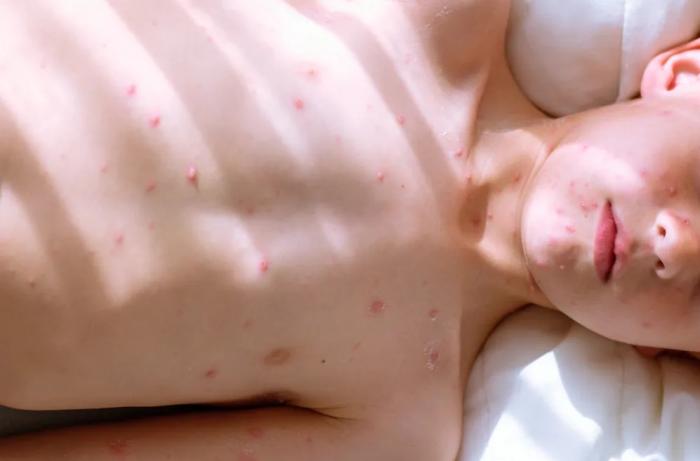 Conheça a 'Gripe do Tomate' , que afeta crianças na Índia