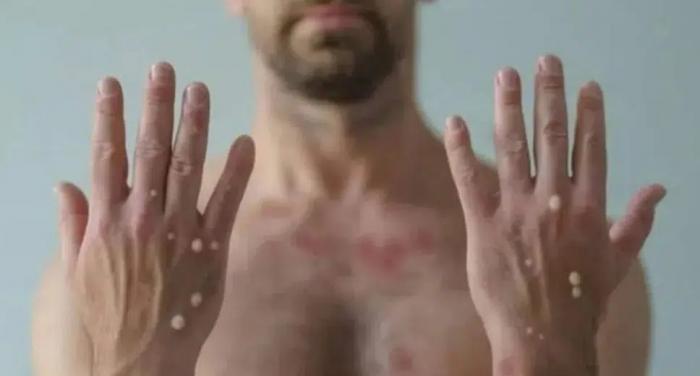 AMAZONAS: 40 casos de Monkeypox; registro é o maior da Região Norte