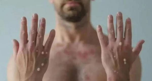 AMAZONAS: 40 casos de Monkeypox; registro é o maior da Região Norte