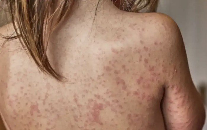 Sarampo avança e acende alerta para vacinação no Brasil