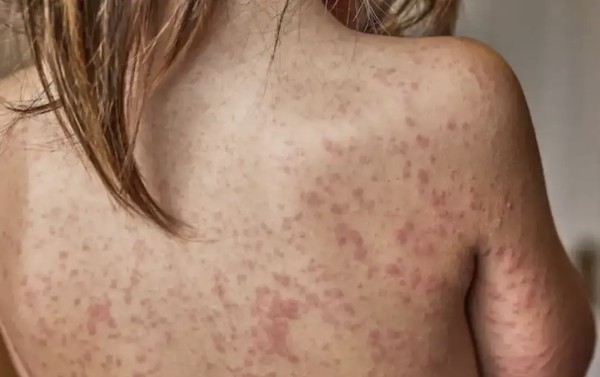 Sarampo avança e acende alerta para vacinação no Brasil